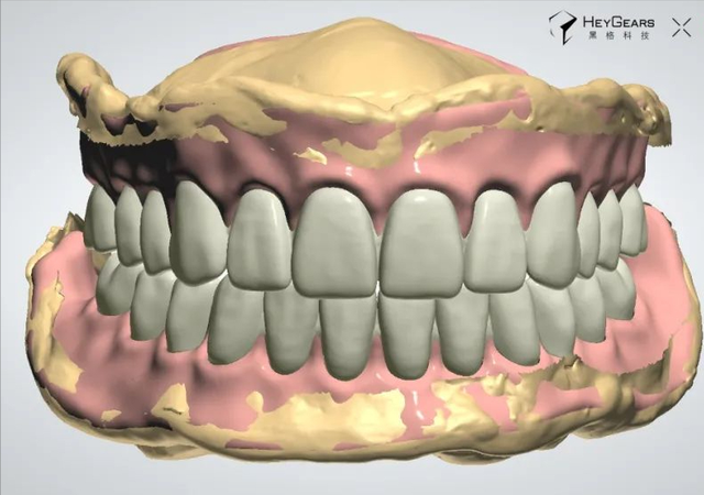 数字化让全口义齿变成性价比之王？嫌种牙又贵又麻烦的快看过来