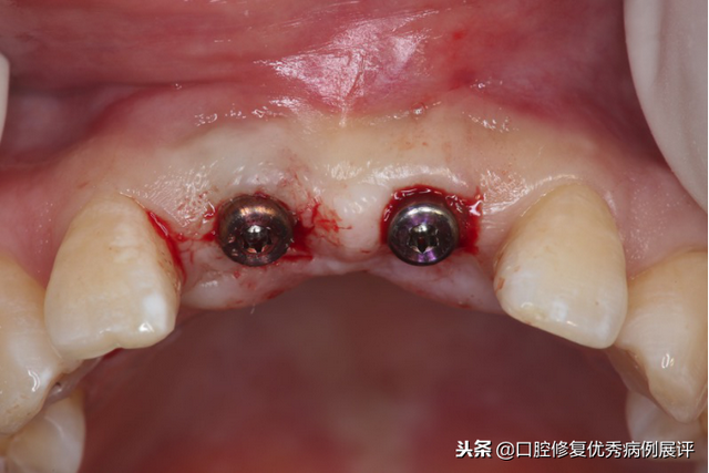 展评优秀病例赏析｜Asc全瓷角度基台一体冠进行种植前牙美学修复