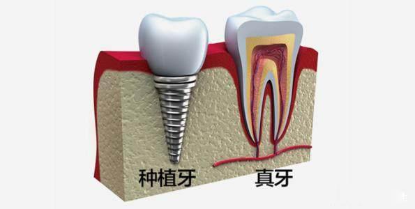 种植牙多少钱？贵不贵哦？