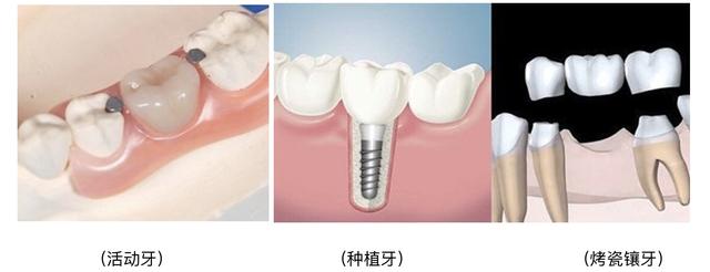 王立超博士告诉你什么是种植牙