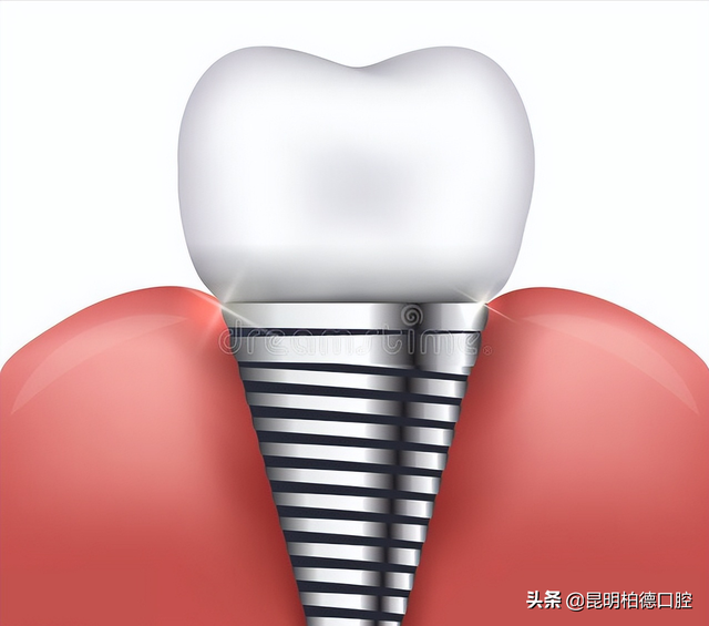 「牙齿那些事儿」No.167丨种植牙掉了还能再种吗？
