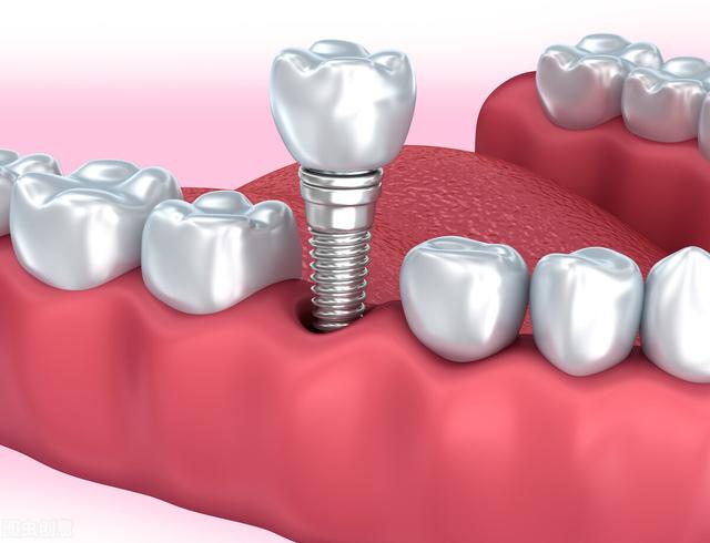 种牙只选对的，不选贵的！掌握3个步骤，选择适合自己的种植牙
