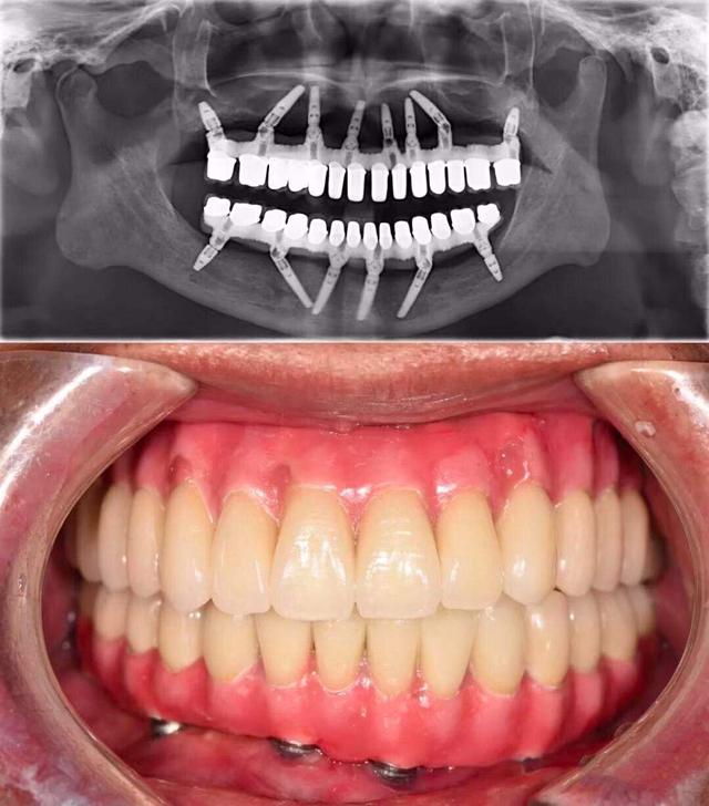 口腔种植效果怎么样  术前准备很关键
