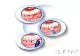 种植牙不得不知的养护经