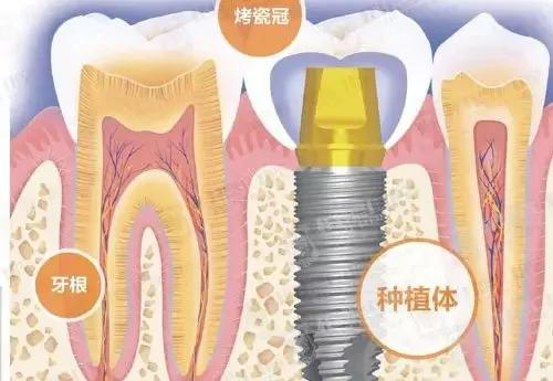 种植牙到底是怎么“种”的？