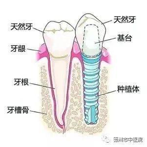 德州市中医院口腔科种植牙：你若好好待它，它便一生相随