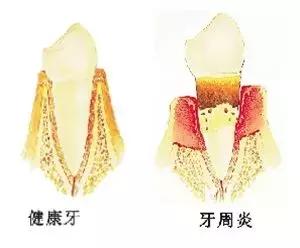 当种植牙遇上香烟，你怕了吗？