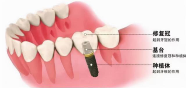 北京整牙：种植牙和烤瓷牙哪个不疼？