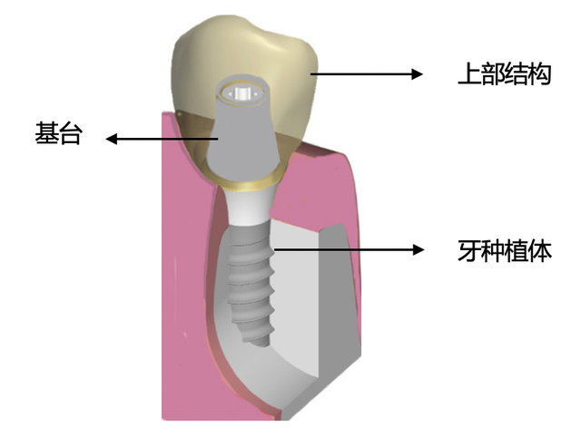 种植牙大揭秘｜什么是种植牙？
