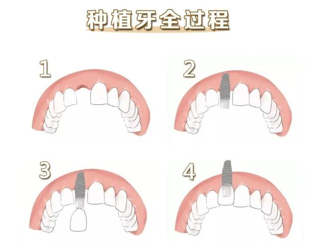 社区里也能种植牙啦！种牙安全吗？有哪些流程？