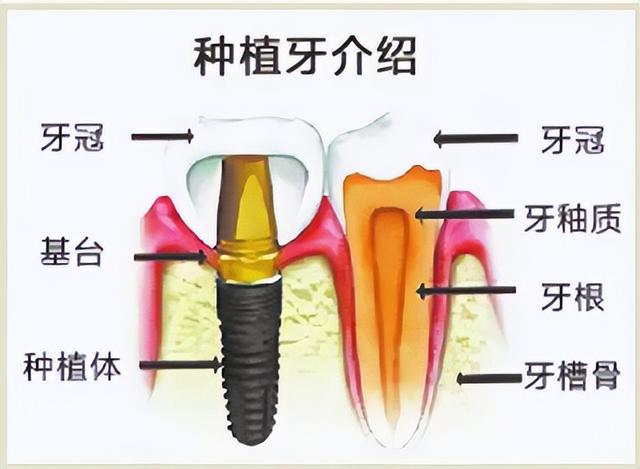 种植牙大揭秘｜种植牙是怎么回事？