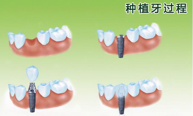 种植牙能用电动牙刷吗？四大误区危害深远