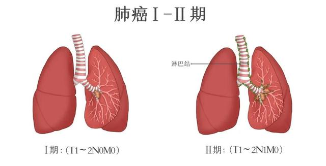 肺癌复发转移这么治，让癌细胞避无可避