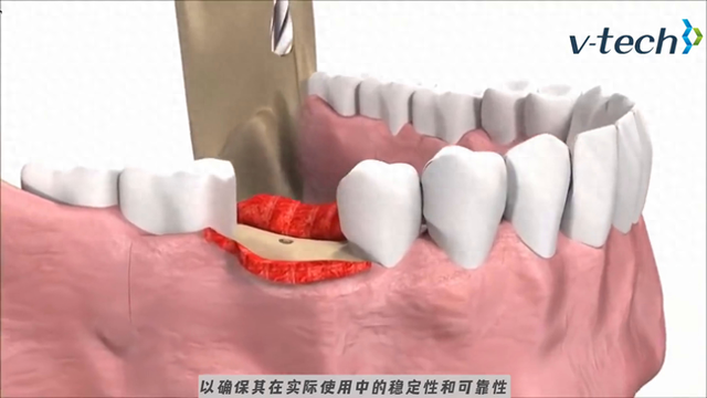 医疗行业｜种植体的测量应用_V-Tech台超集团 Micro