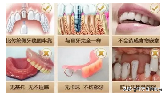 作为种植牙亲身经历者，看看他们做种植牙10年后的真实感受！