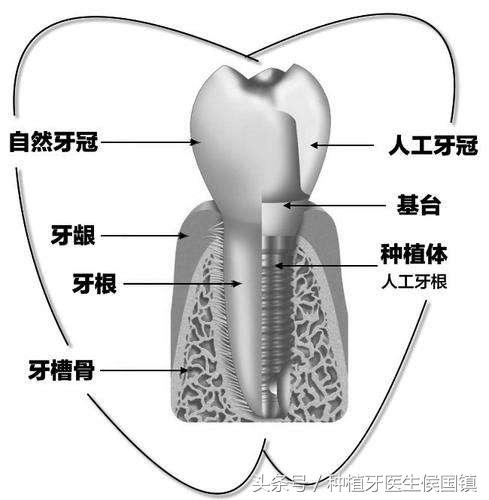 前牙或后牙缺失，该如何“精明”的选择种植牙牙冠