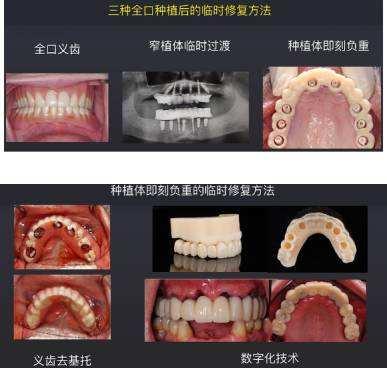 什么是即刻负重种植牙？一场手术就可以结束吗？听听牙医的科普