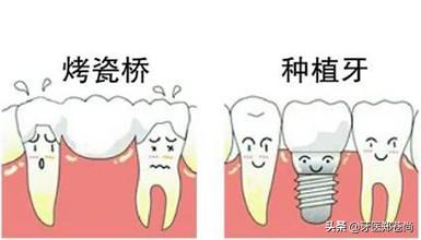 烤瓷牙好，还是种植牙好？患者有两颗缺失牙