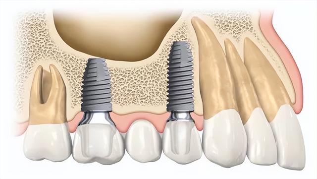 缺牙终于可以便宜种牙了！带您了解“种植牙集采”