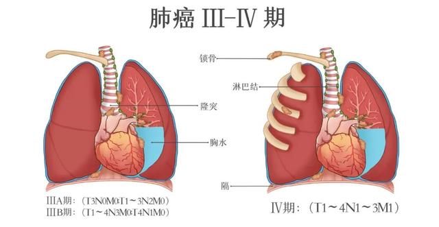 肺癌复发转移这么治，让癌细胞避无可避