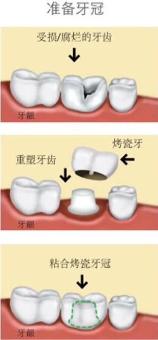 种植牙第二期：你不得不了解的那些事儿——牙冠断了怎么办？