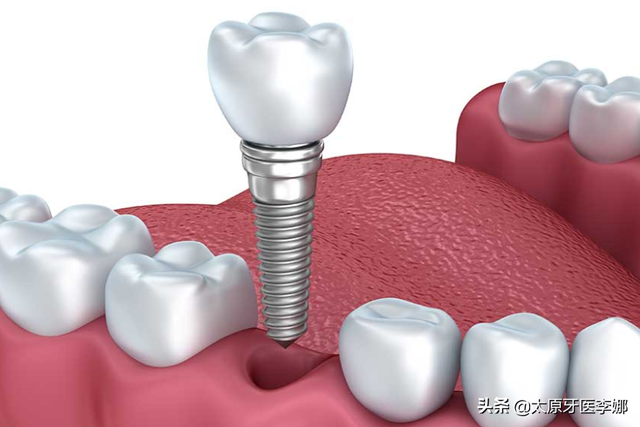 想要种植牙，你要符合那几点要求？