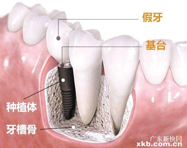 你关心的种植牙问题，我们都帮你厘清了