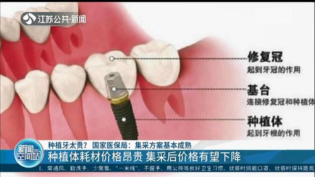 种植牙动辄一两万？国家医保局：集中采购方案基本成熟