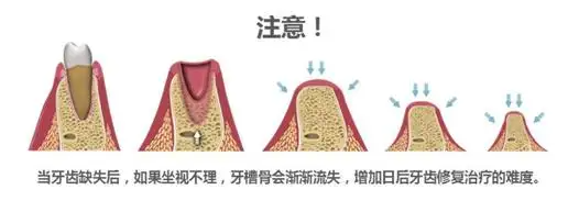 什么时候种牙比较好？专家提醒这几个时间点勿错过