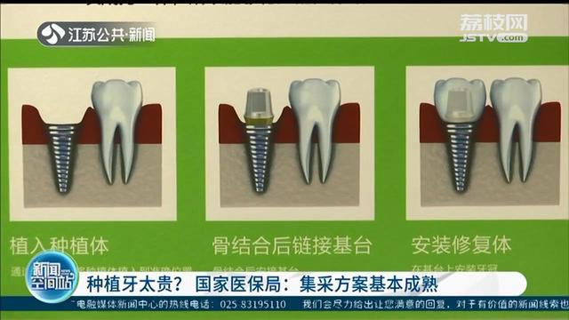 种植牙动辄一两万？国家医保局：集中采购方案基本成熟