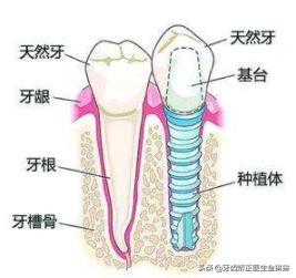 牙医手记：种植牙可能会带来的并发症以及日常如何做好保养