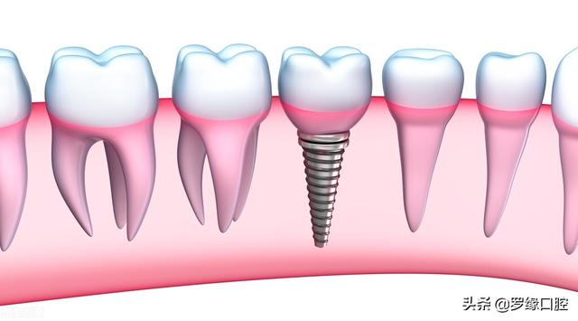 公布上海种植牙价格表，种植牙多少钱一颗，看看吧