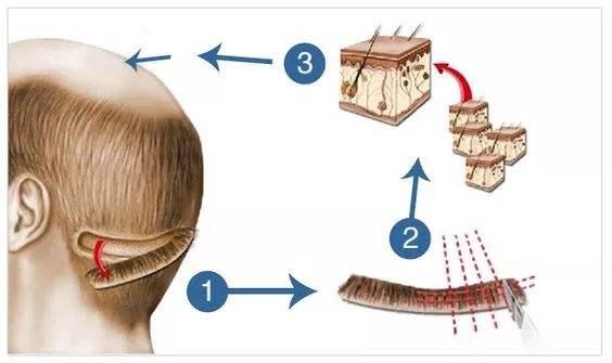 网上说：头发的生命只有三年，植发效果是不是三年就没啦！