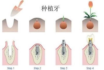 牙齿种植的最佳时机