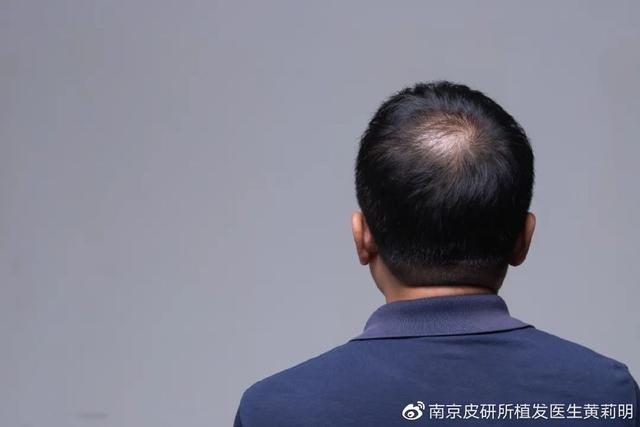 这些植发谣言，一定不要再轻信啦！