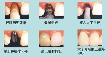 特别提醒这5种人慎选种植牙，以免发生严重的后果