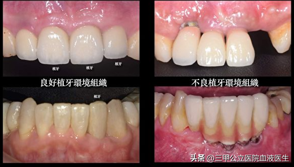 口腔医生绝对不会告诉你种植牙过程中的几点“秘密”