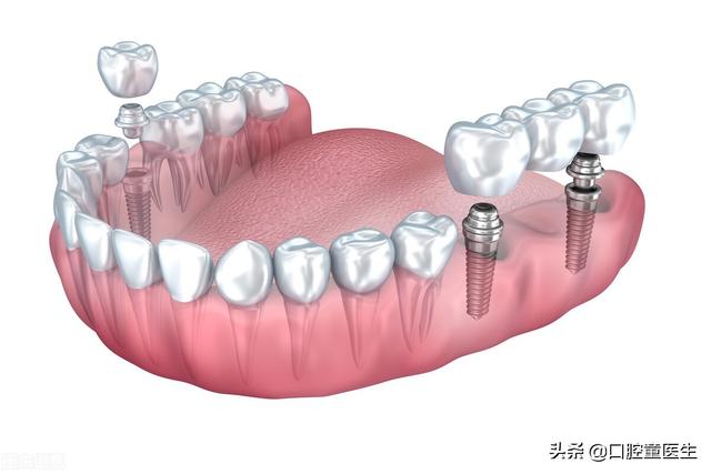 一篇文章全面了解什么是种植牙及其优点、适应人群和治疗流程