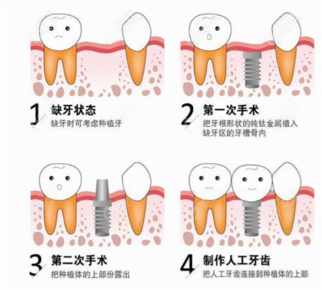 老年人牙槽骨吸收严重，是否可以做种植牙？