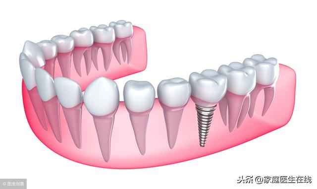 种植牙易有副作用？牙科专家：种植牙成功率在97%以上
