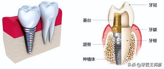 做了种植牙，可别忘了这份保养秘籍