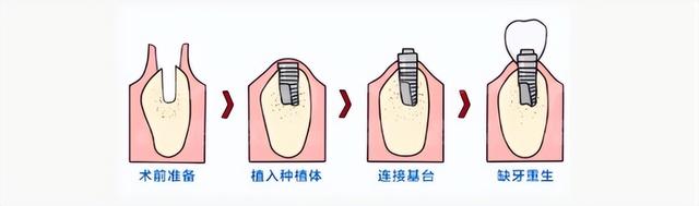 种植牙是怎么“种”出来的？看完这篇就懂了