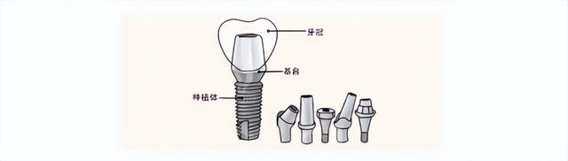 种植牙是怎么“种”出来的？看完这篇就懂了