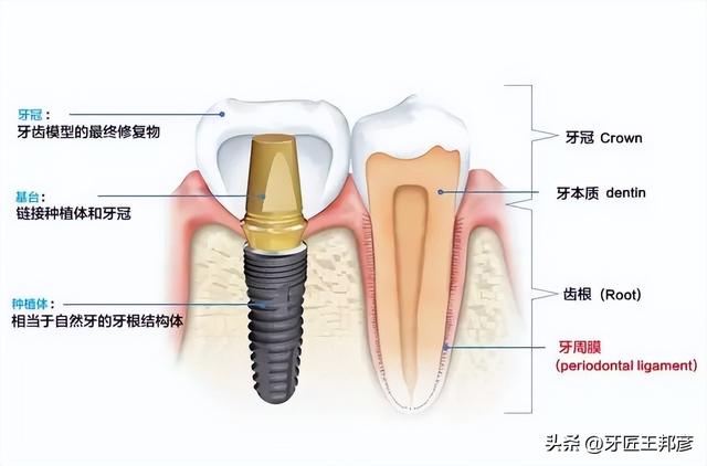 做了种植牙，可别忘了这份保养秘籍