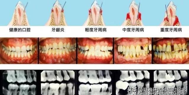 怀孕期间牙龈出血，小心影响到宝宝