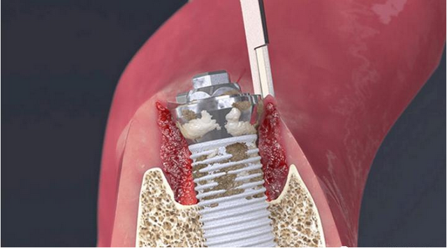 镶牙和种植牙，究竟哪个更好？不吹不黑，今天给你说清楚