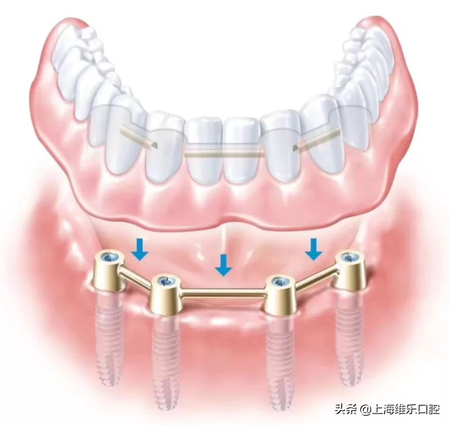 缺牙市民别错过！数字化种植牙4颗修复半口牙，能节省大笔费用