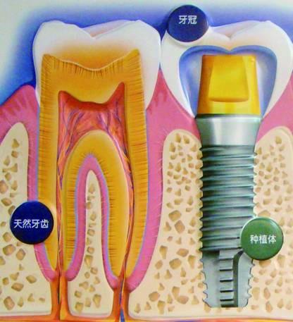 牙种好，随便咬？种植牙的六大误区你了解吗？
