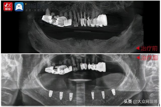 淄博可恩口腔医院六旬老人种牙记