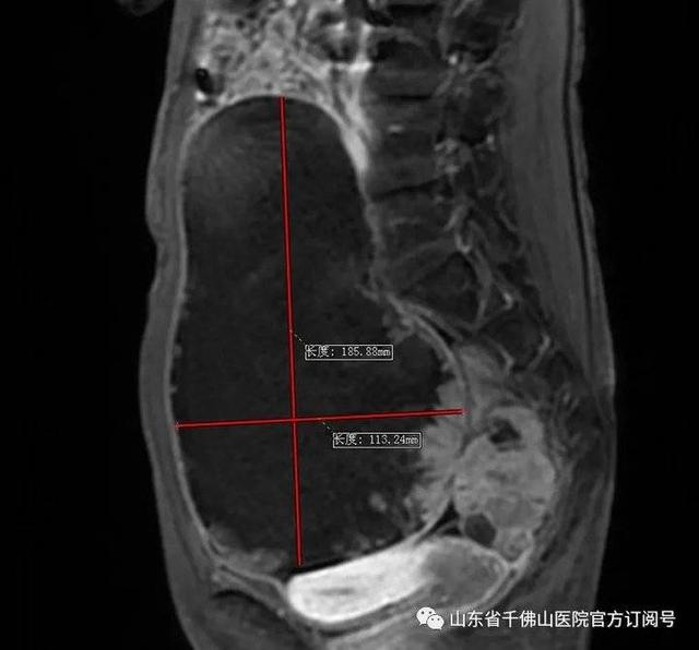 山一大一附院多学科合作切除一腹部多发巨大肿瘤